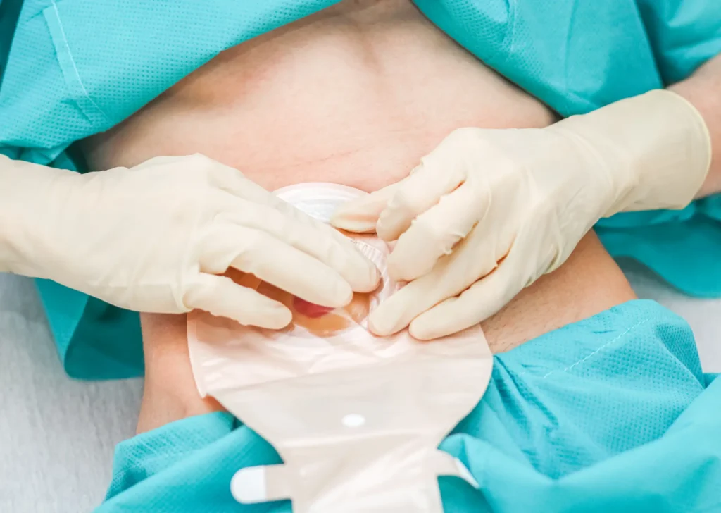 Hands demonstrating correct technique for attaching a colostomy bag to a stoma.